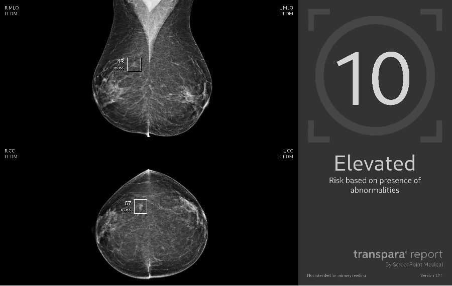 Jsme první pracoviště v ČR, kde bude mamografii hodnotit kromě lékařů navíc ještě umělá inteligence